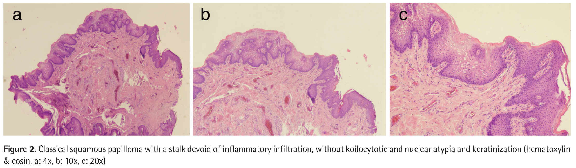 Squamous papilloma urethra. Skin cancers papilloma ugola rimedi